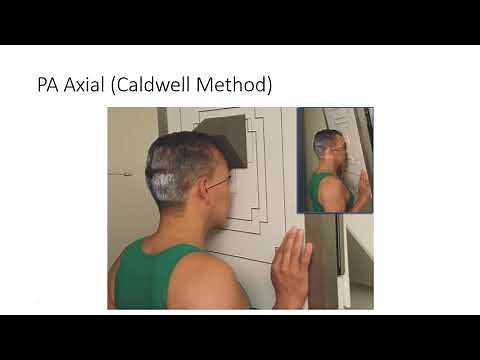 Radiographic Positioning of the Paranasal Sinuses