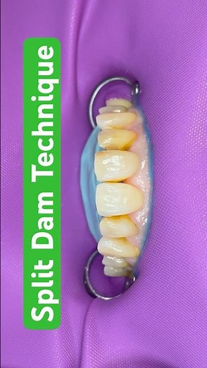 Rubberdam Split Dam Technique Step By Step #rubberdam #rubberdamisolation #dentist #fy #fyp #fypp