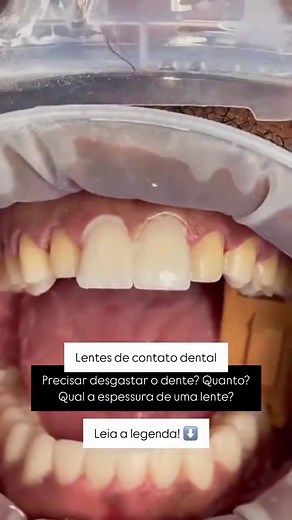 Quanto custa para colocar uma lente de contato? Logo mais falaremos so...