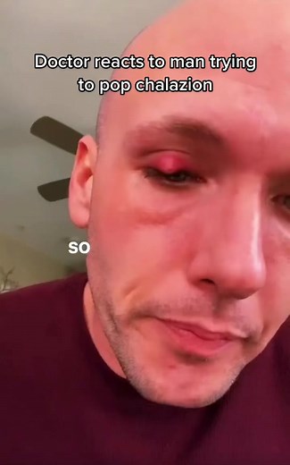 Avoid Popping Your Chalazion - Doctor's Advice