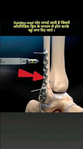 Ankle joint Fibula Bone Fracture Surgery | 3D Animation #shorts