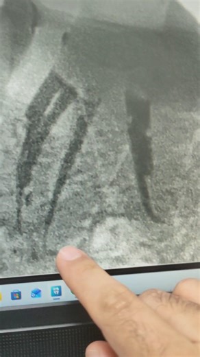 Oral Care By Dr Muqsit on Instagram: "Endodontic treatment of mandibular ist molar with SAP. Beautiful anatomy in mesial root with 3 canals and lateral fills and distal hook at the apex. DME followed by composite restoration. @dr_muqsitfazili #rootcanaltreatment #midmesialcanal #dentistry #oralcarebydrmuqsit #dentistryworld"