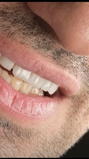 Smile design #dentist #fpd #doctor #rootcanaltreatment #smiledesign #satisfying #shorts