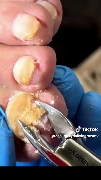 Removing a Gross Ingrown Toenail: A Podiatrist's View