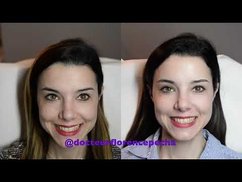 Vidéo Avant/Après injection de Botox ou Toxine Botulique en dynamique