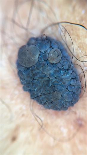 Dermoscopy - Skin cancer on Instagram: "Unna nevus / intradermal nevus Wobble sign 📸 @dermlite DL5 Courtesy of @bedingustavo #dermatology #dermatologia #skin #skincancer #melanoma #dermoscopy #dermatoscopy #dermatoscopia #pele #medicine"