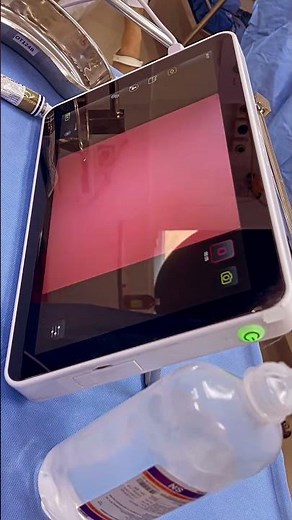 Awake Fiberoptic Intubation for case of TMJ Ankylosis with no mouth opening.