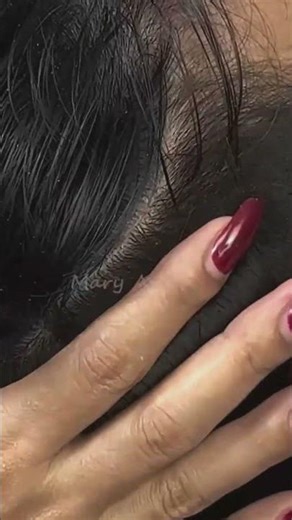 Remove BIG Dandruff Flakes Scratching On Back Side