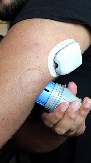 Diabetic Sensor Change: Freestyle Libre 2 Plus Guide
