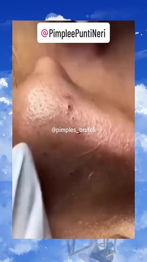 satisfying extraction popping acne abscess squeeze blacheads removal (43)