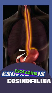 🍽️ Alimentos a Considerar en el Cuadro de Esofagitis Eosinofílica 🧑‍⚕️ La esofagitis eosinofílica (EE) es una afección inflamatoria del esófago que ocurre cuando los eosinófilos, un tipo de célula inmunitaria, se acumulan en el esófago, lo que provoca dolor, dificultad para tragar y otros síntomas digestivos. Aunque la causa exacta de esta condición aún no está completamente clara, se ha asociado con alergias alimentarias y ciertos desencadenantes. Una dieta adecuada puede ayudar a controlar l