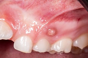 What is gingival granuloma and how to treat it | Emergency Live