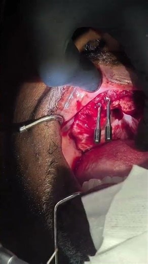 Gum Overgrowth Removed: Before & After Transformation