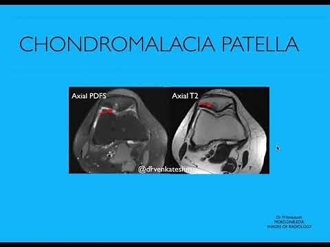 Chondromalacia patella -MR features and classification
