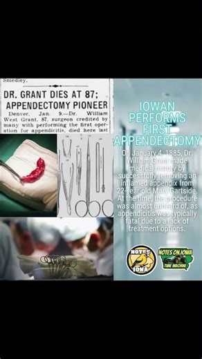https://www.notesoniowa.com/post/iowa-performs-first-appendectomy-iowa-time-machine-january-4-1885