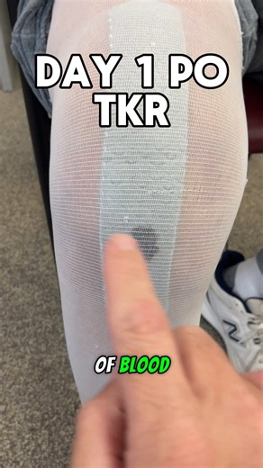 51K views · 159 reactions | Day 1 after total knee replacement...