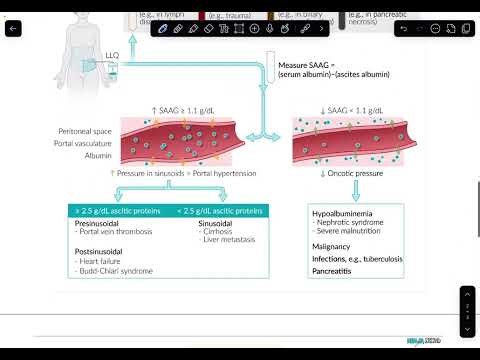 Serum ascites albumin gradient (SAAG)