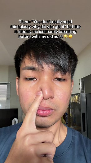 Rhinoplasty Before & After: Improved Breathing & Sleep