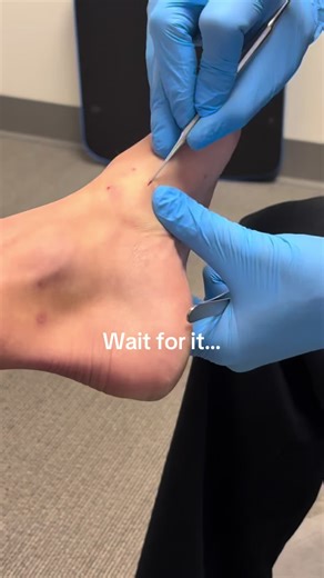 Foreign body removal- Sea Urchin spine! The patient was jumping off her surfboard and landed on the urchin. And this wasn’t the first time. #surgery #fyp #doctor #ocean #podiatry