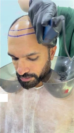 Hair Transplant OT Day at Clion Care