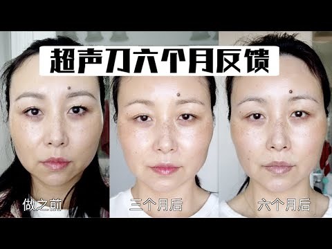 超声刀六个月后前后对比｜Ultherapy Six Months Update, Before & After[MsLindaY]