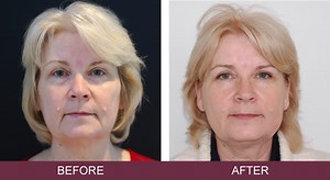 Silhouette Soft Thread Lifts | Non-Surgical Face Lift | Skin Excellence Clinic