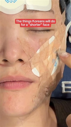 수💛 on Instagram: "The things Koreans will do for a ‚shorter‘ face. Recently, I got the treatment called EMFACE which reflects Korean’s obsession with having a shorter-looking face because it makes you look younger. They’re even getting 인중축소 수술 - literally ‚philtrum reduction surgery‘ - which sounds absolutely bizarre to me. The Emface uses this machine that lifts your face while building muscle at the same time. Here’s what’s happening: RF energy tightens skin while HIFES technology contracts