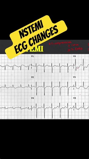 NSTEMI ll ECG Changes #ecg #ecginterpretation #heartattack
