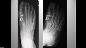 Hallux Valgus: Proximal vs Distal Osteotomies