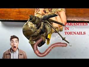 TREATMENT OF Ingrown Toenails, Onychomycosis Is Very Hard, Perfect Trimming Process N374