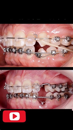 Orthodontic Teeth Correction Progress #medicalstudent #dentist #teethdecay #teethcare