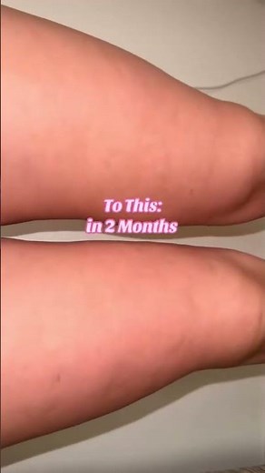 how to get rid of cellulite