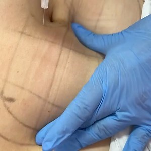 LIPOLYSE une nouvelle prestation de mésothérapie 😎 disponible chez moi 👏🏻 C’est quoi le lipolyse : C’est des composants naturels injectés dans le tissu graisseux sous cutanés qui cassent et fondre la graisse. Après quelques jours la graisse s’évacue par les voies naturelles. C’est quoi son rôle ?! Elle vous aide à perdre du poids et diminuer le tour de taille . Les zones ciblées ? Le menton / les bras / le ventre / les hanches / les cuisses / le dos Prix : entre 5000et 10000 ( la zone ) / une