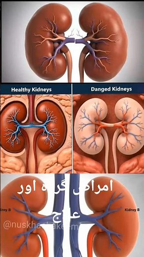 Kidney Diseases: Causes, Symptoms & Effective Treatment | Kidney Health Guide🌿