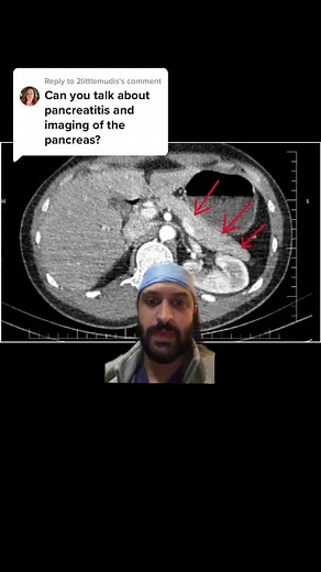 Understanding Pancreatitis: A Radiology Explanation