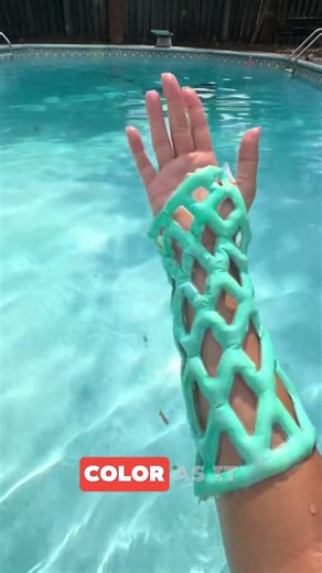 Modern Solution Instead of a Traditional Cast