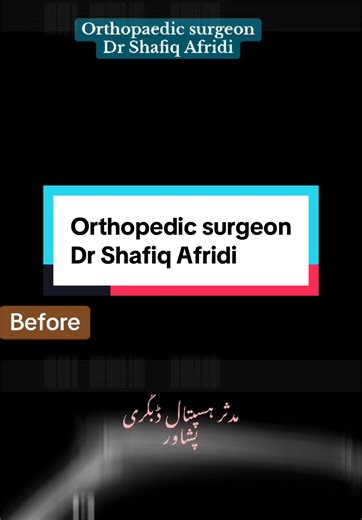 Understanding Elbow Dislocation: Causes and Recovery Steps