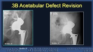 Metal Augments for 3B Acetabular Defects