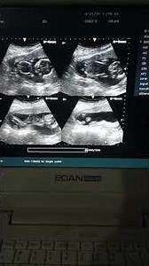 🍼 4 month pregnancy