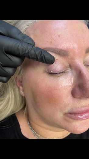 Satisfying Milia Extraction Video