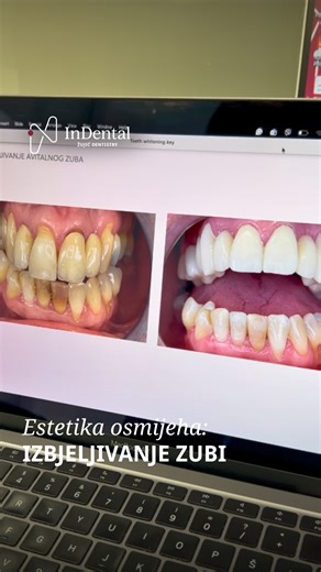 Nijedan filter ne može zamijeniti onaj osjećaj kada se nasmiješ i vidiš prirodno bijele zube. Profesionalno izbjeljivanje omogućit će ti upravo taj doživljaj; brzo, sigurno i s predvidivim rezultatom. U InDentalu koristimo kemijski aktiviran gel Opalescence Boost, što znači da tijekom postupka ne upotrebljavamo lampu. Rezultat je ravnomjerno i učinkovito izbjeljivanje bez oštećenja cakline. Ipak, nije svaki osmijeh spreman za ovaj tretman. Samo zdravi i sanirani zubi mogu se izbjeljivati, i to i