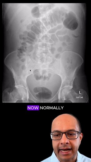 Recognizing Ascites on Abdominal X-ray