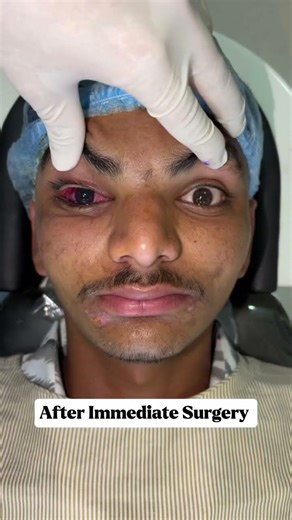 No Age Limit for Squint Surgery From Childhood to Adulthood