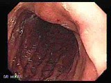 Adenocarcinoma with Signet Ring Cells (1 of 3) • Video • MEDtube.net