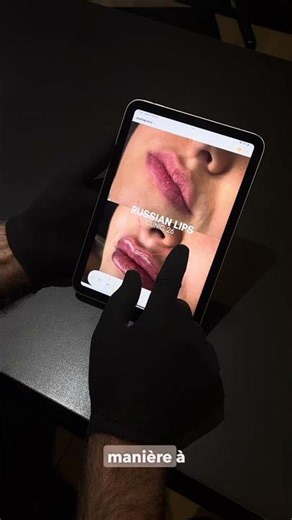 Russian Lips : à quoi servent ces injections pour les lèvres ?