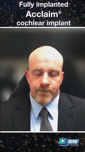 How Does it Work? Cochlear Implant Fully Under Skin Undergoing Clinical Trial at Mayo Clinic