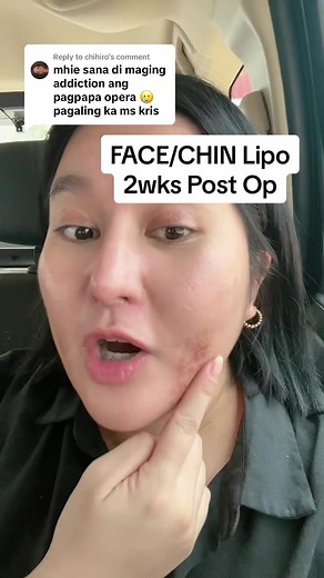 Understanding the Recovery Process After Face and Chin Lipo Surgery