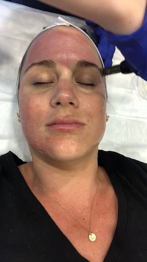 Get 30-second glimpse of a microneedling treatment session in progress, at Water's Edge Dermatology! | Water's Edge Dermatology