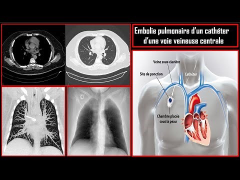 Dossier radiologique 1: Embolie pulmonaire d'un cathéter veineux central