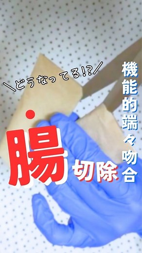 オペ看めろん🍈 | 機能的端々吻合って、どうつながっているの！？について💡 機能的端々吻合 とは、がんなどの病巣を切除したあとの腸管の断端同士を自動縫合器で連続させる吻合法です！ 自動縫合器にはエシュロンやエンドGIAなどを使用することが多いです😊 *******... | Instagram
